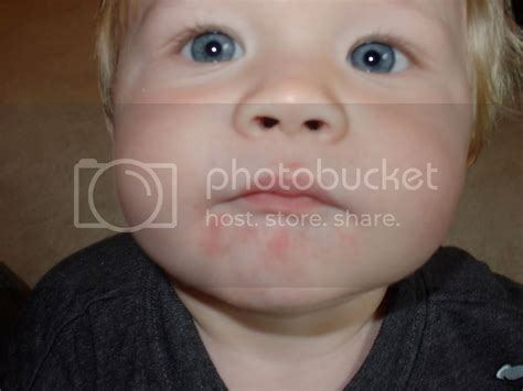 From viral infection rash to food sensitivities to the fever and rash first, a genetic tendency toward dry, irritated skin; Rash around the mouth - BabyCenter