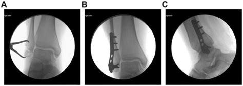 Republication Of “fracture Through A Distal Fibular Tunnel Used For An