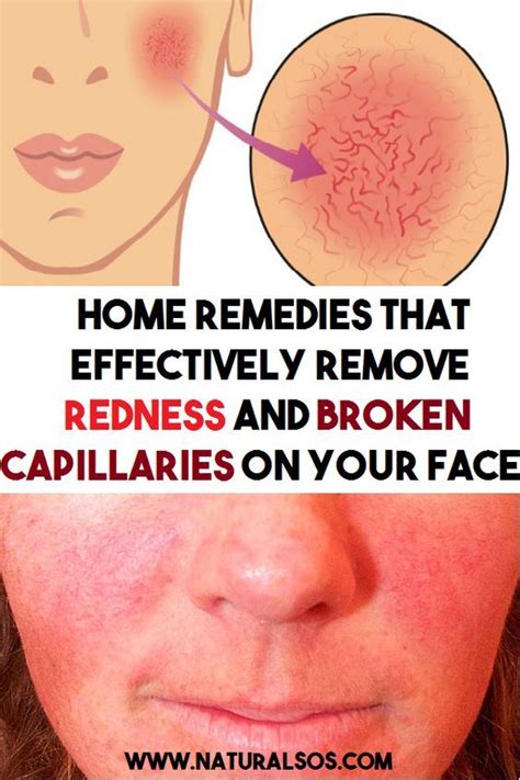 Home Remedies That Effectively Remove Redness And Broken Capillaries On Your Face Redness On