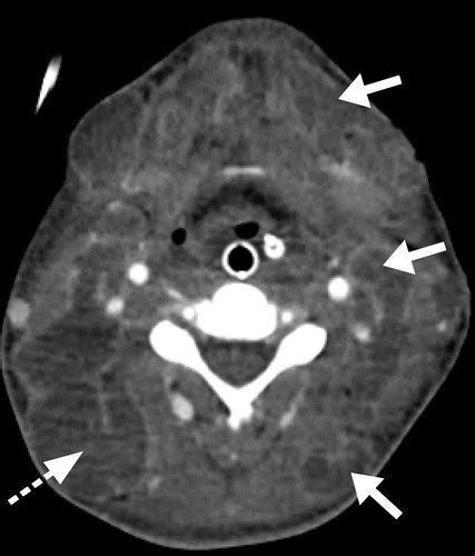 Extrapulmonary Tuberculosis Pathophysiology And Imaging Findings