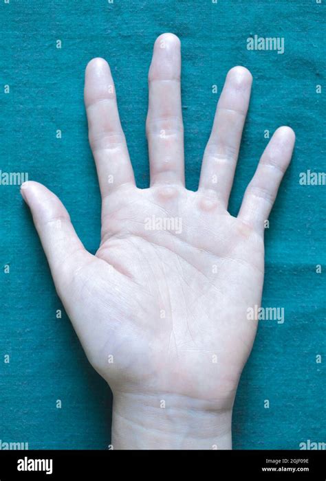 Pale Skin Anemia Hi Res Stock Photography And Images Alamy
