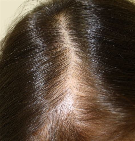 Alopecia Androgénica Femenina Premenopausica Mujeres Pérdida De Pelo