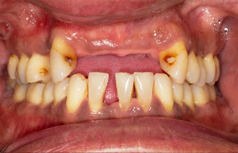 Gum Disease Gallions Reach Dental Clinic