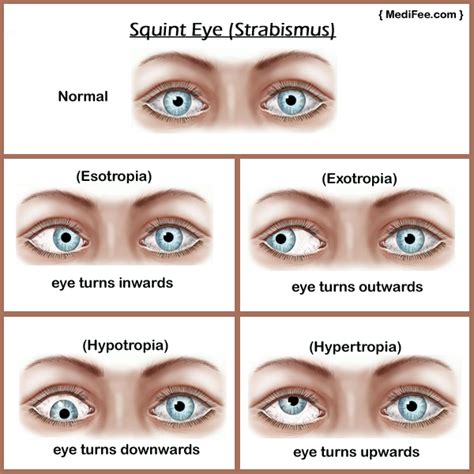 Do You Know About The Strabismus Heres What To Do