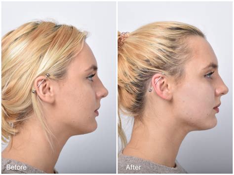 Thread Lift Sydney 1 Cosmetic Doctors Face Neck And Cheek Lift