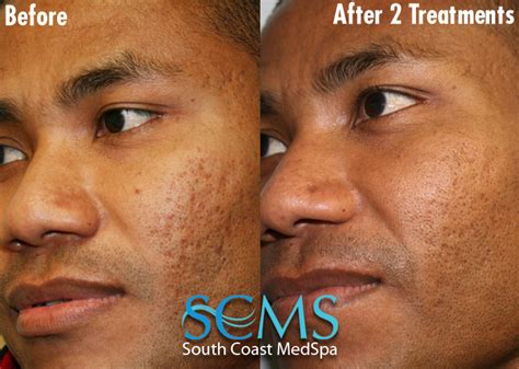 Light And Dark Skin Laser Acne Scar Removal Asian Skin
