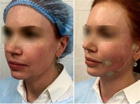 Aptos Thread Facelift Before And After Facelift Info Prices Photos