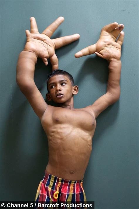 Year Old With Gigantism Of The Hands His Chest Muscles Are