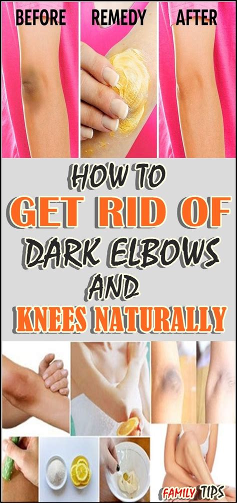 How To Get Rid Of Dark Elbows And Knees Naturally Dark Elbows