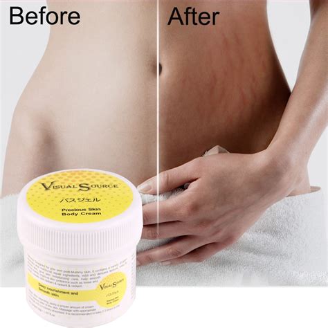 Stretch Marks Scar Removal Smooth Skin Cream For Maternity Skin Repair