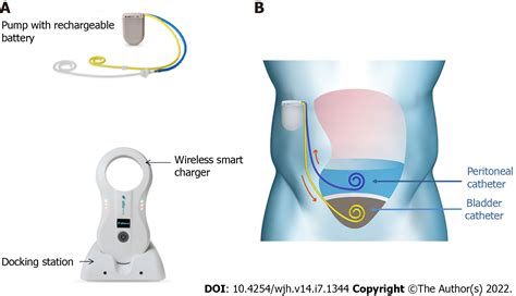 Alfapump® Implantable Device In Management Of Refractory Ascites An Update