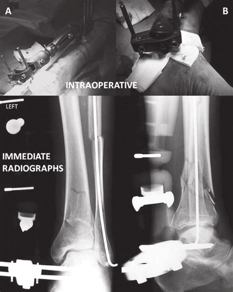 Fracture Of The Left Distal Tibia With Comminution Classifi Ed As 43