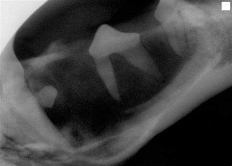 Dentigerous Cyst Flickr Photo Sharing