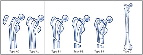 Periprosthetic Hip Fractures An Update Into Their Management And
