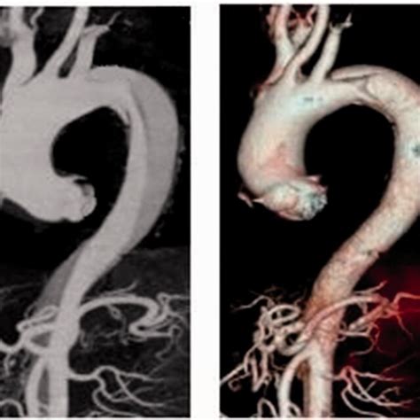 Aortic Computed Tomography Angiography Of Complex Stanford Type B