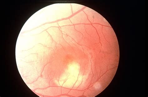 Bests Disease Retina Image Bank