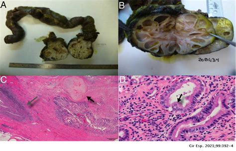 Pancreas Sparing Duodenectomy For The Treatment Of Mature Teratoma