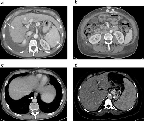 Imaging Finding Of Portal Hypertension Many Findings On Abdominal