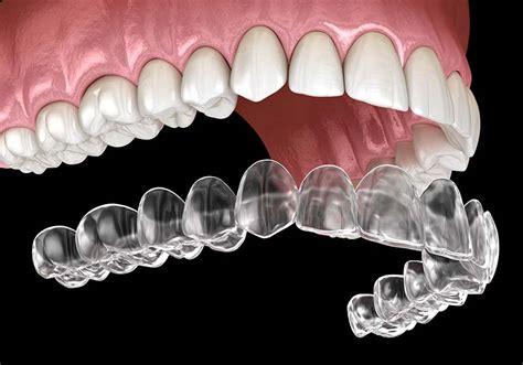 Different Types Of Invisalign Treatment Gevey G