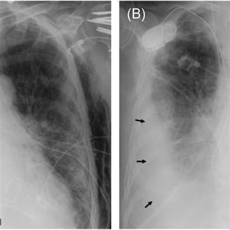 A Chest X‐ray Images After Nasogastric Tube Placement With The Tip Of