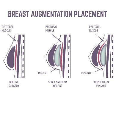 Breast Augmentation In Miami From Unique Aesthetic Center