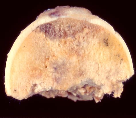 Pathology Outlines Avascular Necrosis