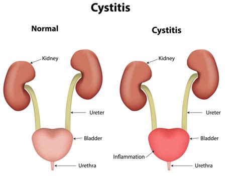 The Ultimate Guide To Natural Treatment For Cystitis