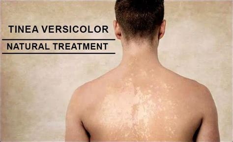 Natural Treatment For Tinea Versicolor Safest Way To Heal It
