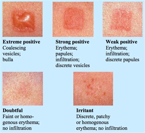 Suddenly Allergic Contact Dermatitis Suddenly And Asthma