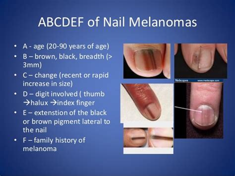 Melanoma usually appears as a dark brown to black unusually shaped spot, and when it occurs near or under the toenails it can look like a long dark with melanoma, the surrounding toe skin may take on a darkened appearance as well. Big Toenail Has Vertical Light Brown Line: Melanoma ...