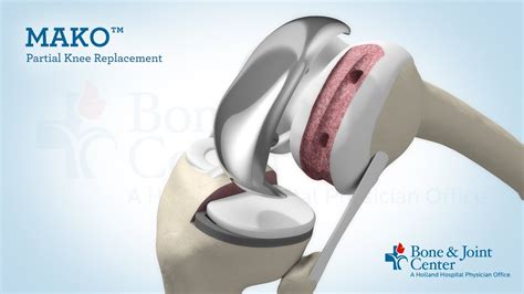 Partial Knee Replacement Mako Robotic Arm Assisted Surgery Technology
