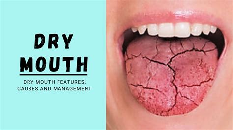 Dry Mouth Xerostomia Youtube