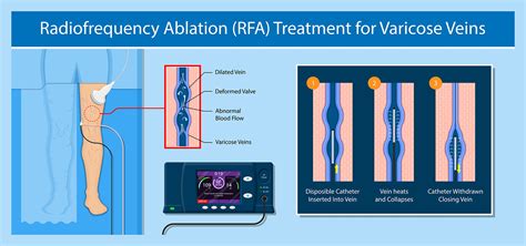 Radiofrequency Ablation Near Me Endovenous Laser Mequon Wi