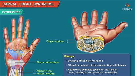 Introduction — carpal tunnel syndrome (cts) refers to the complex of symptoms and signs brought on by compression of the median nerve as it travels through the carpal tunnel. Carpal Tunnel Syndrome Animation: Etiology, Symptoms ...