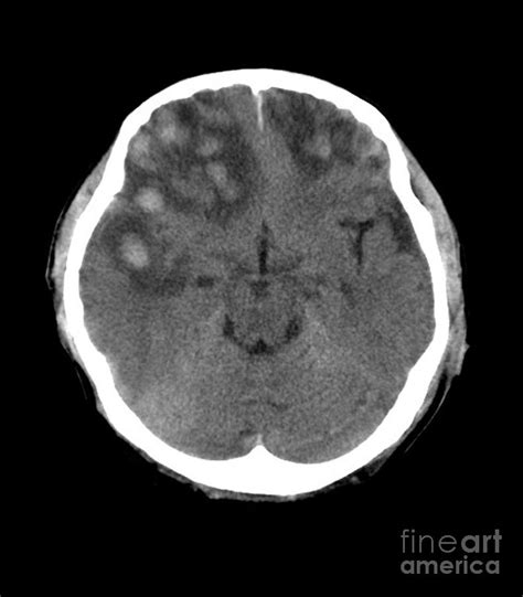 Brain Hemorrhage Mri Scan Photograph By Du Cane Medical Imaging Ltd