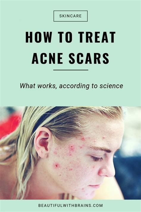 How To Treat Acne Scars The Complete Guide Beautiful With Brains