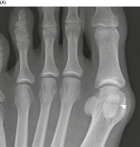 Fractures And Dislocations Of The Metatarsals And Toes Anesthesia Key