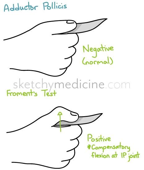 Ulnar Nerve Stepwards