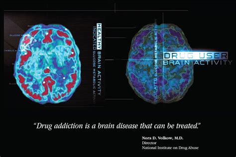 Addicts Who Live In The Moment May Benefit Most From Certain Kinds Of Treatment Neuroscience News