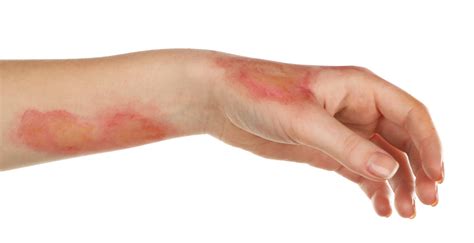 Why You Should Visit Your Local Urgent Care For An Infected Burn