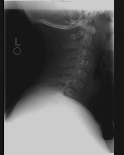 Cervical Spine Imaging In Trauma
