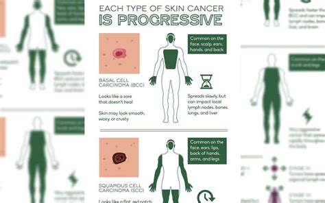 Save Your Skin From This Dangerous Disease How To Detect Skin Cancer