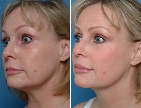 Injectable Fillers Photos Aesthetic Surgery Center Naples Fl