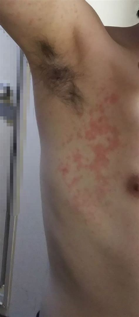 ある日、気が付いたら脇の下周りと、二の腕に湿疹のような ...