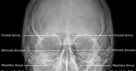 Radiographic Anatomy Sinuses Pa 15 Caldwell