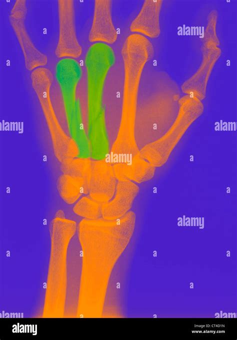 Fractured Finger X Ray Stock Photo Alamy