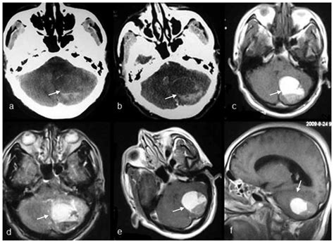 Imaging Findings Of Extraventricular Choroid Plexus Papillomas A Study