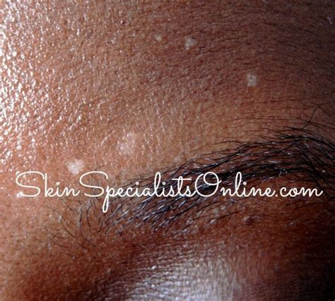 Vitiligo Skin Specialists Online