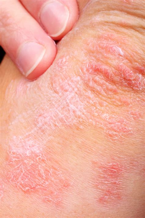 Explainer What Is Eczema And What Can You Do About It