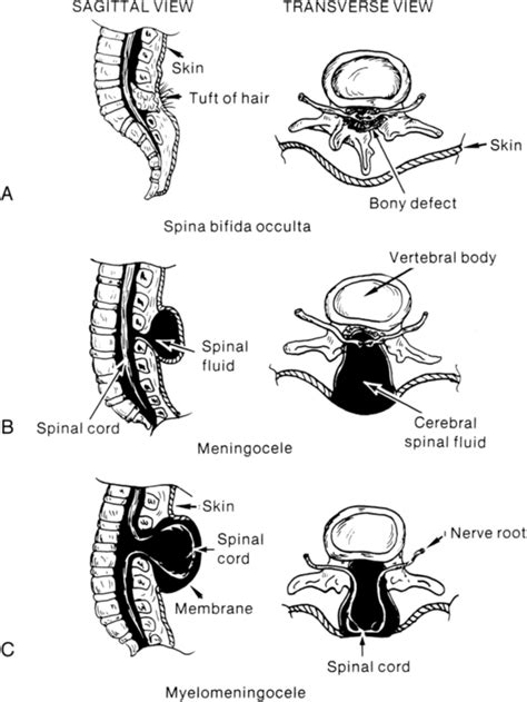 Spina Bifida A Congenital Spinal Cord Injury Musculoskeletal Key